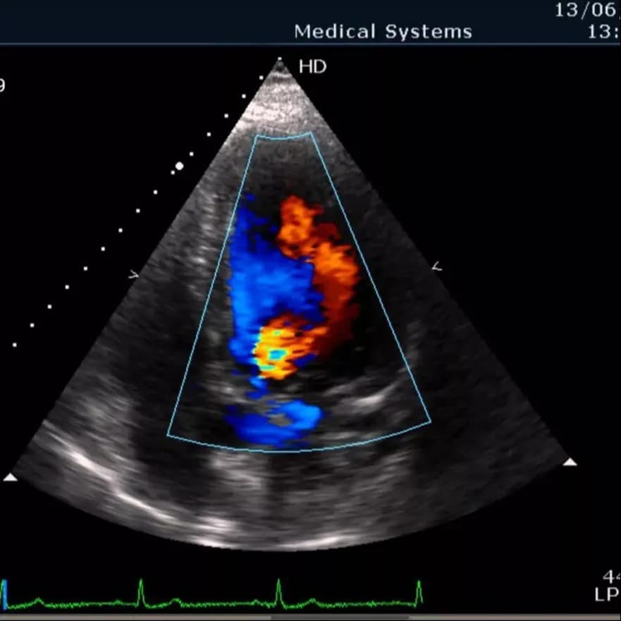 2D Echo Color Doppler