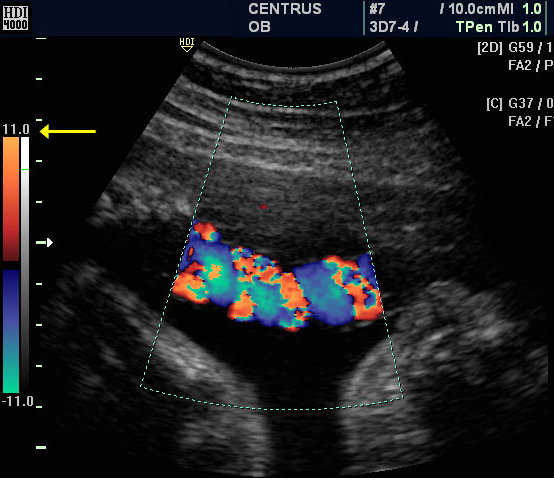 Color Doppler / Doppler Ultrasound